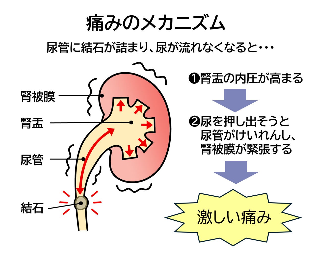尿路結石の痛みのメカニズムは、尿管に結石がたまり、尿が流れなくなると、腎盂の内圧が高まり、尿を押し出そうと尿管がけいれんし、腎被膜が緊張して、激しい痛みが起こります。