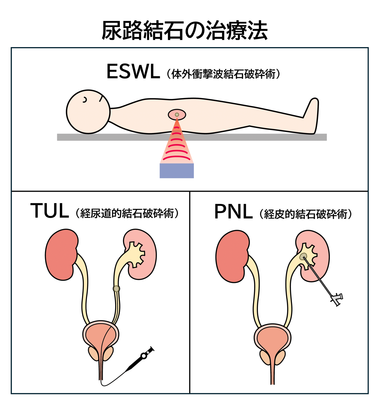 尿路結石の治療法には、衝撃波を体の外から当てて、結石を小さく砕くESWL（体外衝撃波結石破砕術）、尿道から内視鏡を入れて結石をレーザーなどで砕くTUL（経尿道的結石破砕術）、背中にちいさな穴をあけて内視鏡を挿入し、結石を破砕するPNL（経皮的結石破砕術）があります。