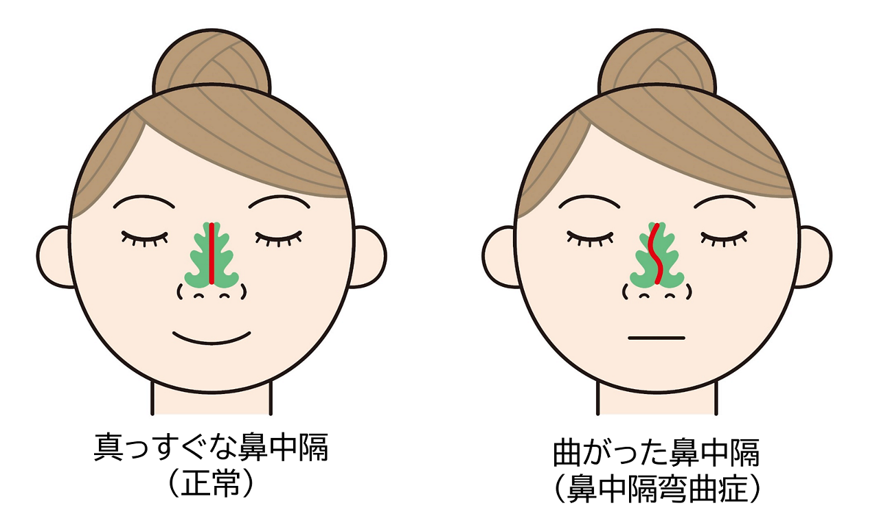 正常なまっすぐな鼻中隔のイメージ図と鼻中隔弯曲症（びちゅうかくわんきょくしょう）の曲がった鼻中隔のイメージ図