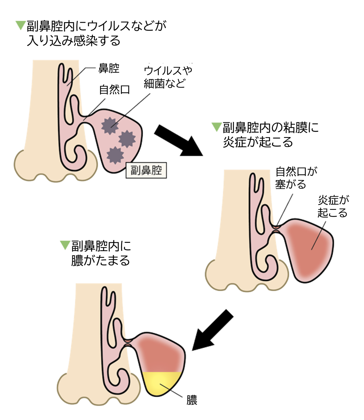 好中球性副鼻腔炎（蓄膿症）は、副鼻腔内にウイルスなどが入り込み感染し、副鼻腔の粘膜に炎症が起こり自然口が塞がると、副鼻腔内に膿がたまります。