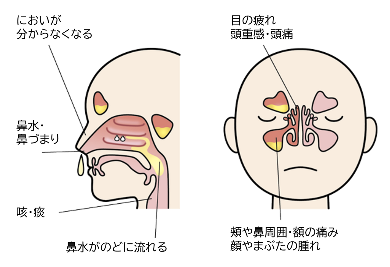 好酸球性副鼻腔炎の症状には、鼻水・鼻づまり、においが分からなくなる、咳・痰、鼻水がのどに流れる、目の疲れ、頭重感・頭痛、頬や鼻周囲・額の痛み、顔やまぶたの腫れがあります。