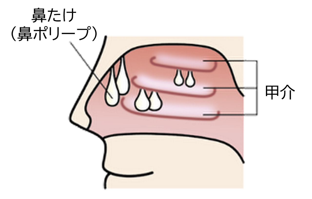 好酸球性副鼻腔炎で「鼻たけ（鼻ポリープ）」が多数できたイメージ図