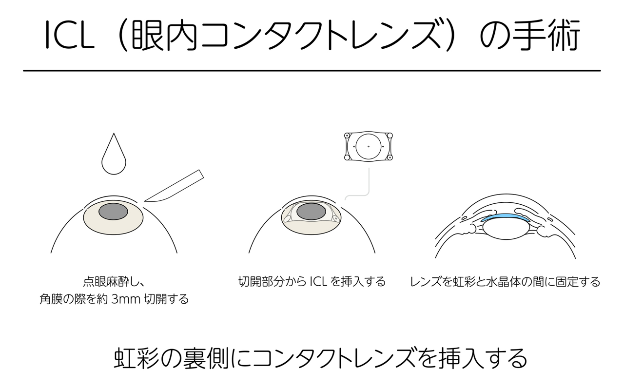 ICL（眼内コンタクトレンズ）の手術は、点眼麻酔後、角膜の際を約3㎜切開し、切開部分からICLを挿入、レンズと虹彩を水晶体の間に固定するという手順で行われる。虹彩の裏側にコンタクトレンズを挿入することで視力を矯正する。
