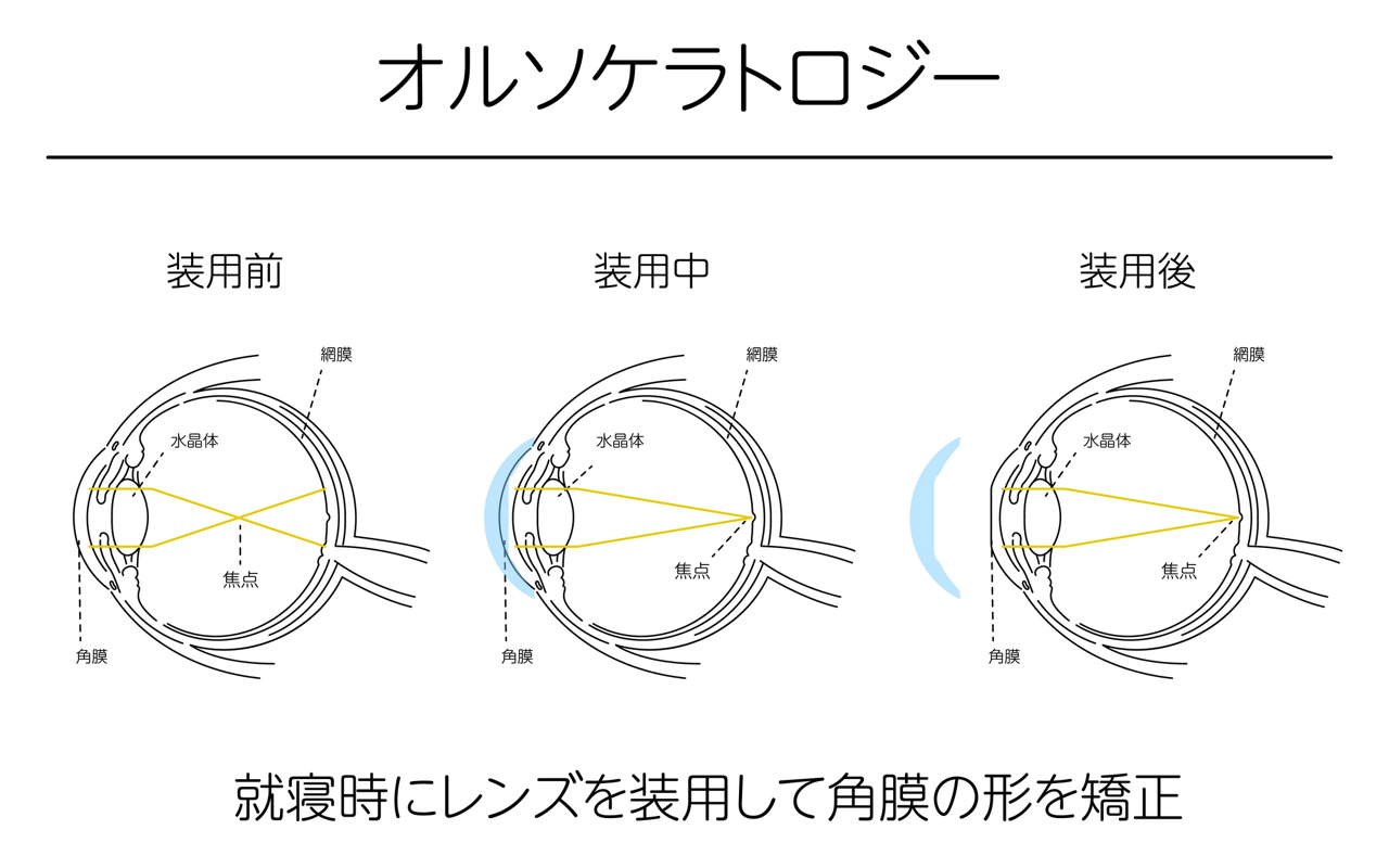 オルソケラトロジーは、就寝中にレンズを装用して、角膜の形を矯正する治療法