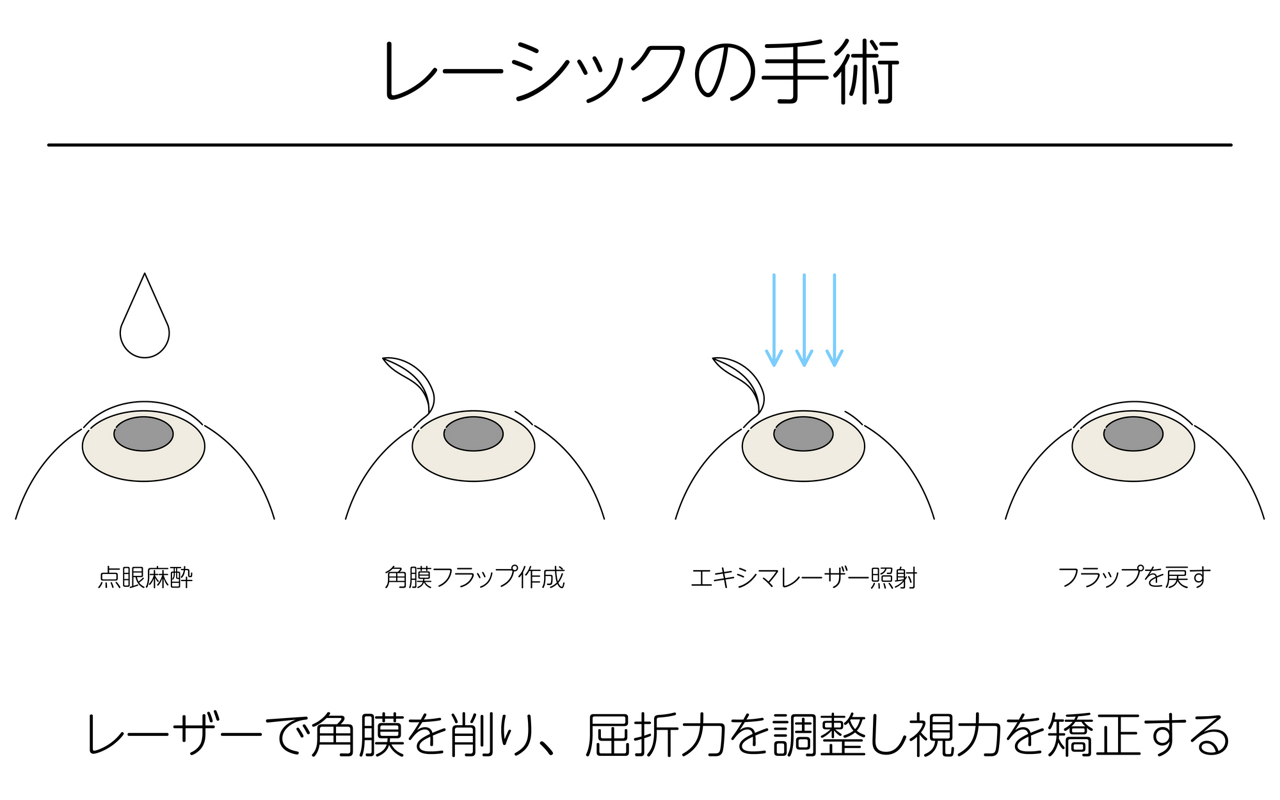 レーシックの手術は、点眼麻酔後に、角膜フラップを作成、エキシマレーザーを照射し、フラップを戻すという手順で行われる。レーザーで角膜を削り、屈折力を調整し視力を矯正する。