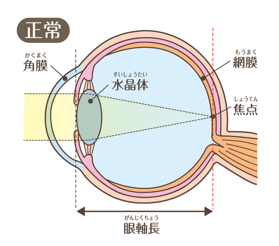 正常な目（角膜と水晶体で光を屈折させ、網膜（もうまく）の上にピントがあっている）と近視のイメージイラスト