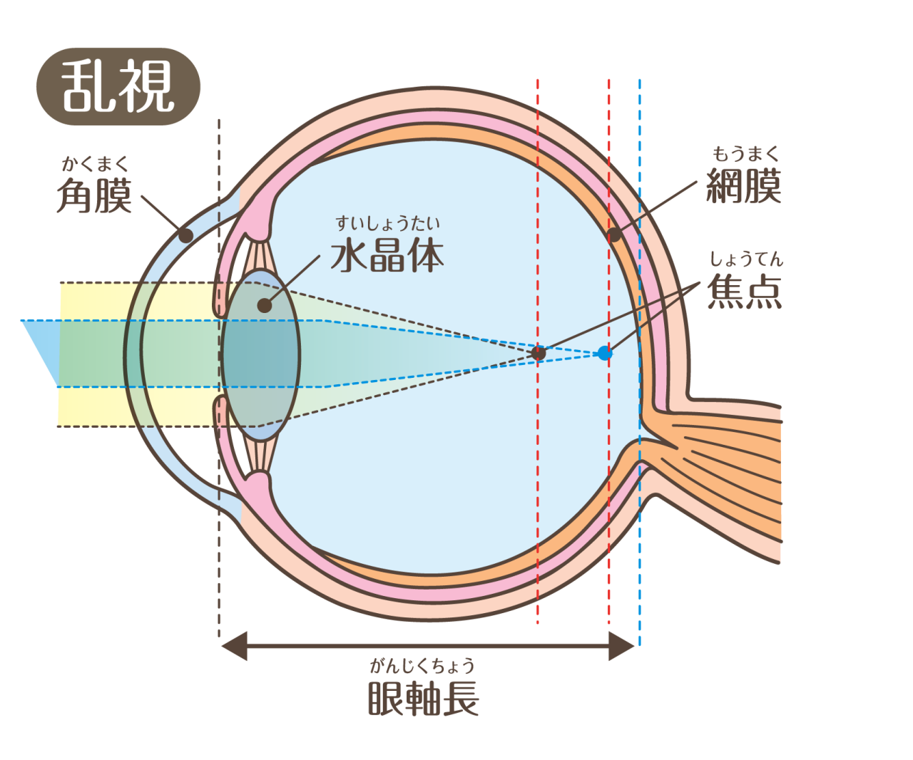 乱視の目（角膜や水晶体がゆがんでいて、複数の場所でピントが合う）のイメージイラスト