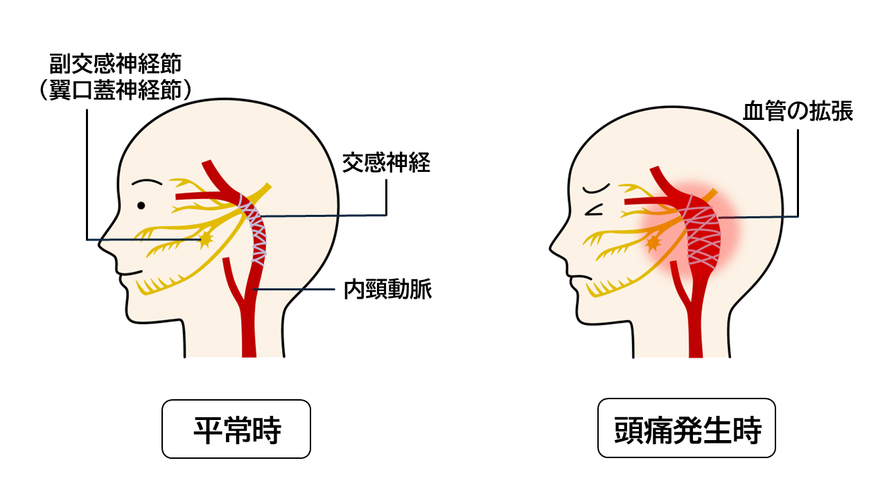 群発頭痛発生時と平常時の、目の奥を通る内頸動脈の状態を示すイメージイラスト。血管が拡張し頭痛が起こる。