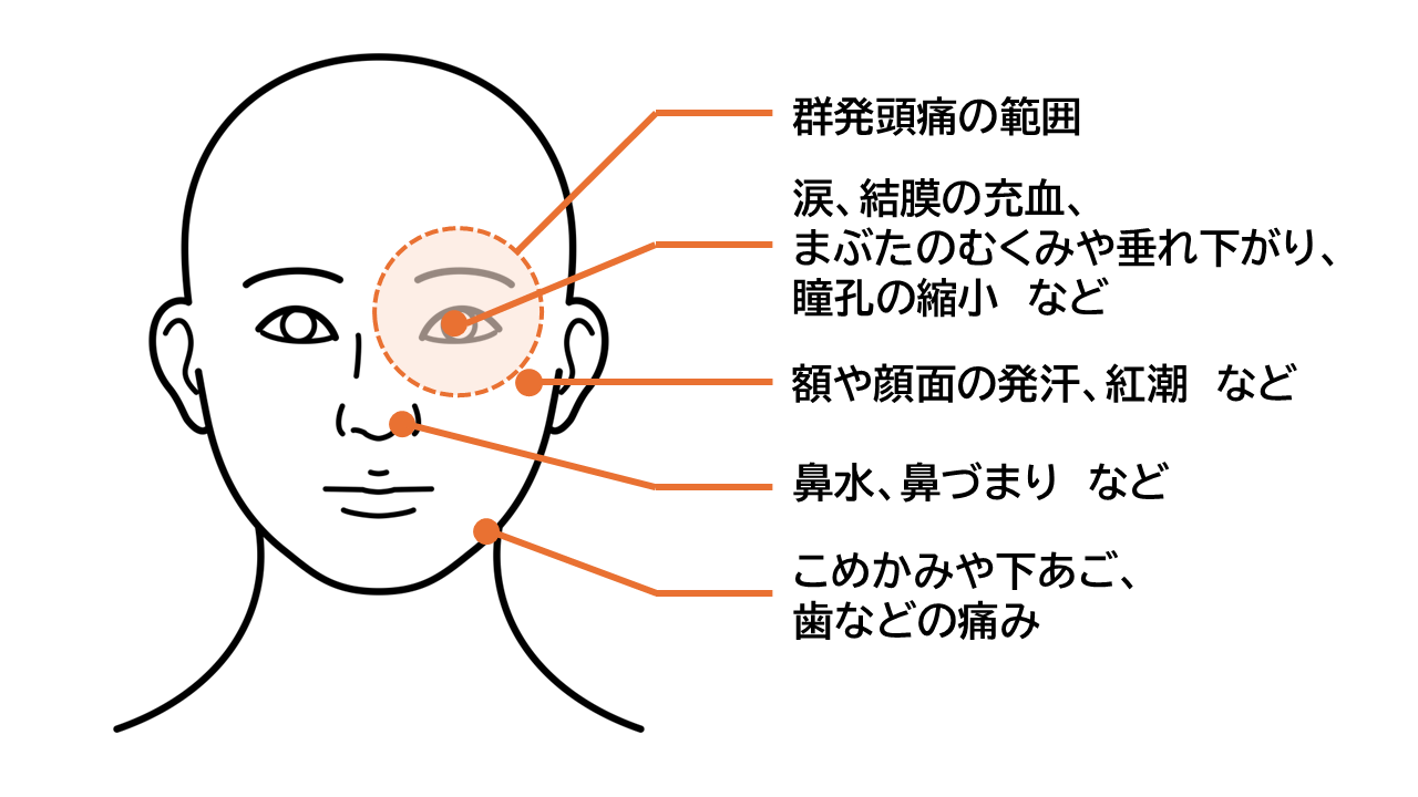 群発頭痛の症状は以下の通り。目の症状は、涙、結膜の充血、まぶたのむくみや垂れ下がり、瞳孔の縮小などがある。顔面の症状は、額や顔面の発汗、紅潮、こめかみや下あご・歯などの痛みがあり、鼻の症状は、鼻水、鼻づまりなどある。