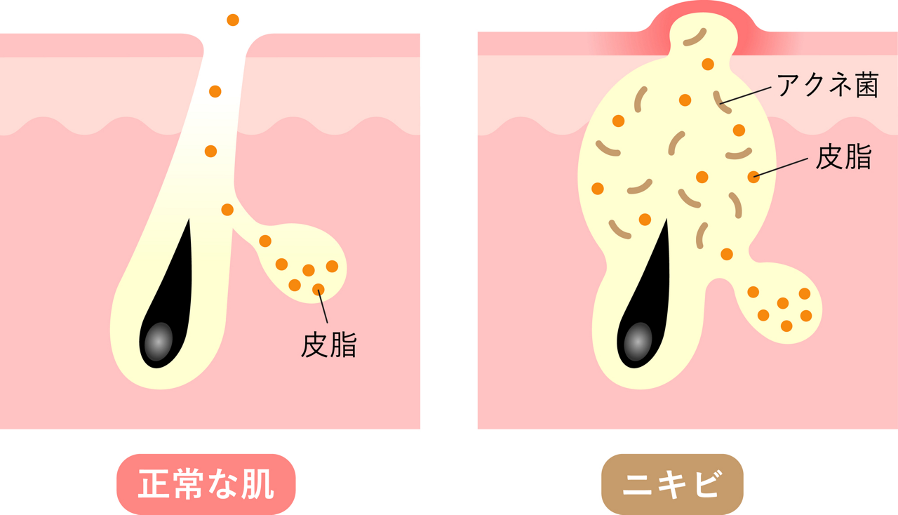 詰まった毛穴の中でアクネ菌が繁殖して起こるニキビと、正常な肌のイメージイラスト
