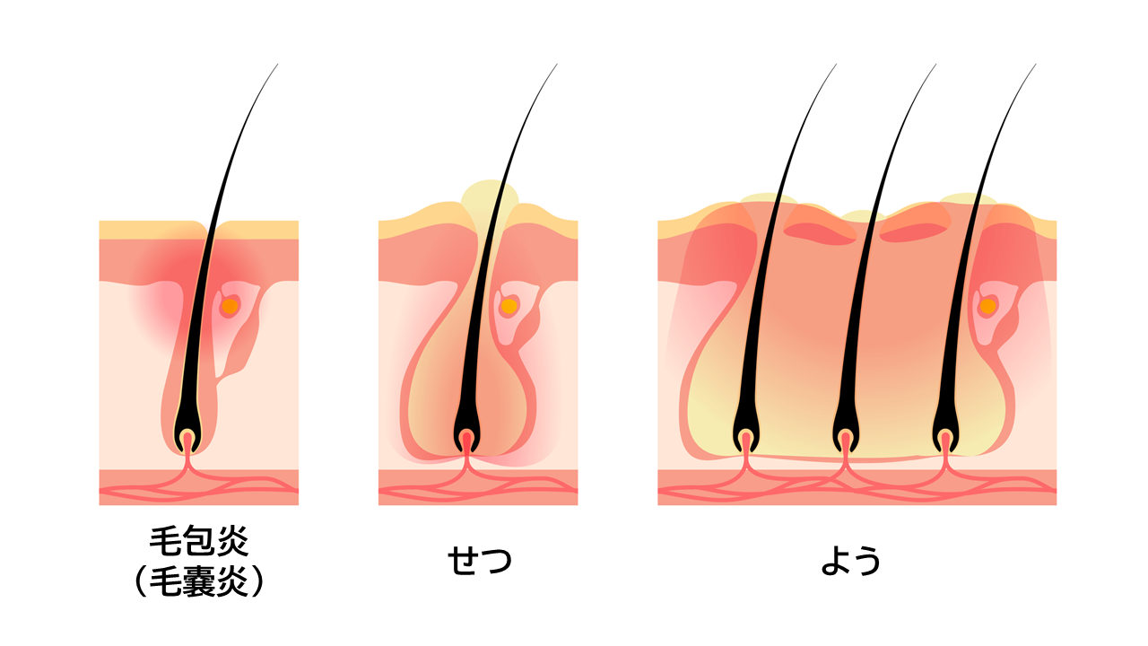 毛包炎（毛嚢炎）と「せつ」「よう」のイメージイラスト