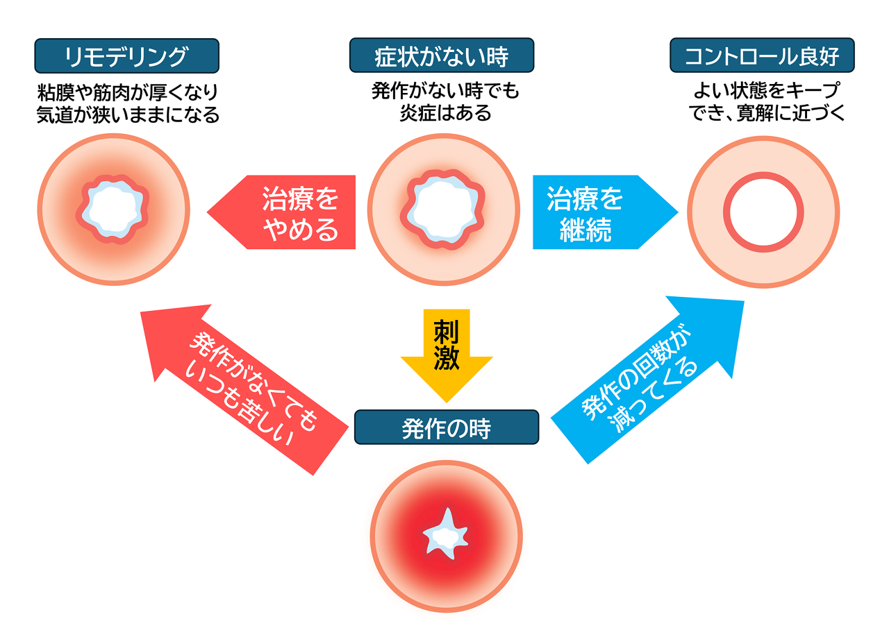 気管支ぜんそくは慢性の病気なので、症状がなくても気道に炎症が起こっている。治療を続けると、発作が起きても回数が減っていき、炎症が収まって寛解に近づくが、途中で治療をやめると、気道の粘膜や筋肉が徐々に厚くなって気道の内部が狭くなる「リモデリング」が起こり、発作がなくてもいつも苦しくなる。