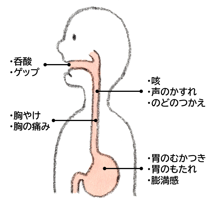 呑酸・ゲップは口、咳・声のかすれ・のどのつかえは喉、胸やけ・胸の痛みは胸、胃むかつき・胃のもたれ・膨満感は胃というように、逆流性食道炎の主な症状を体の部位別にまとめたイメージイラスト