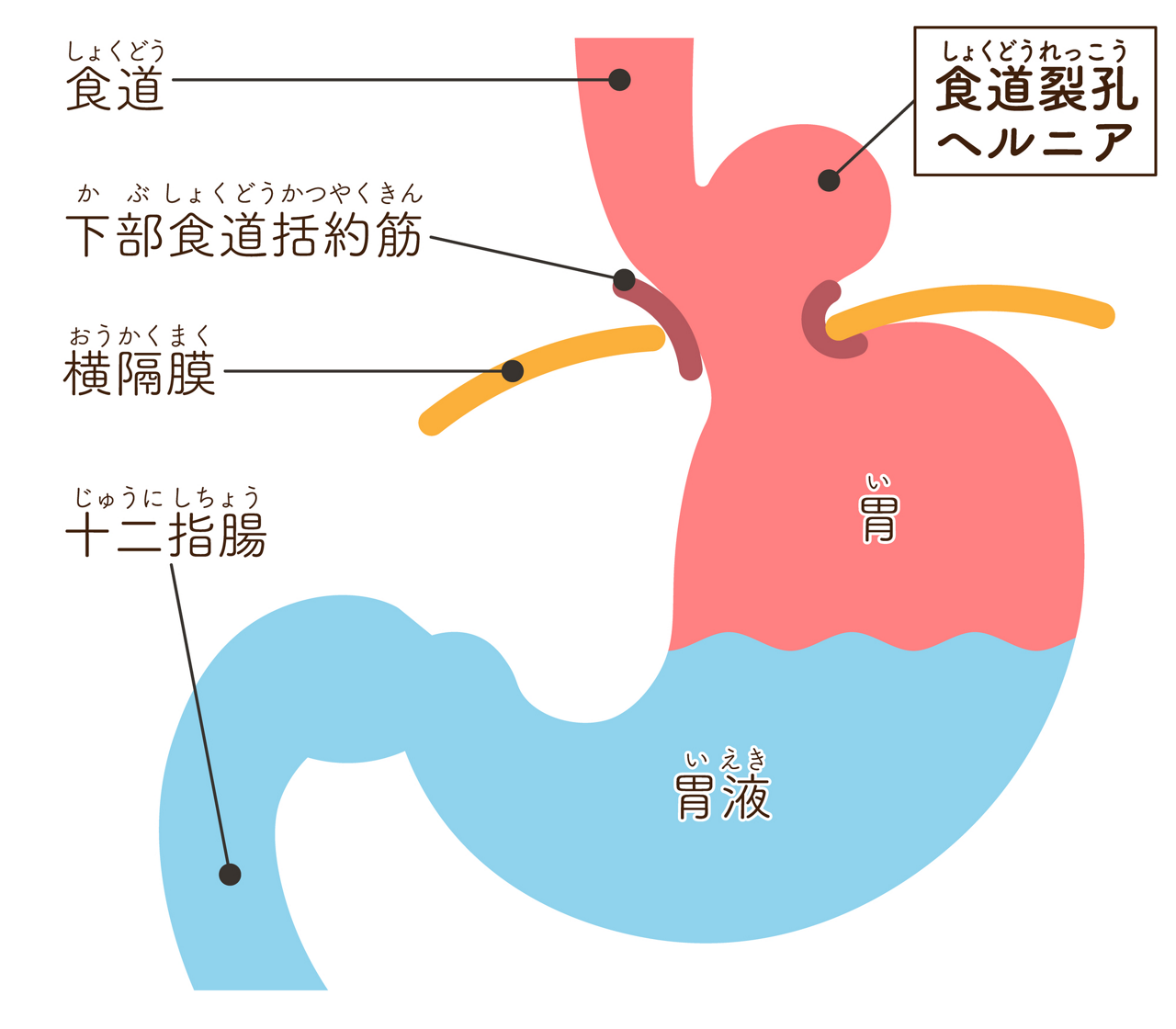 食道裂肛ヘルニアのイメージイラスト