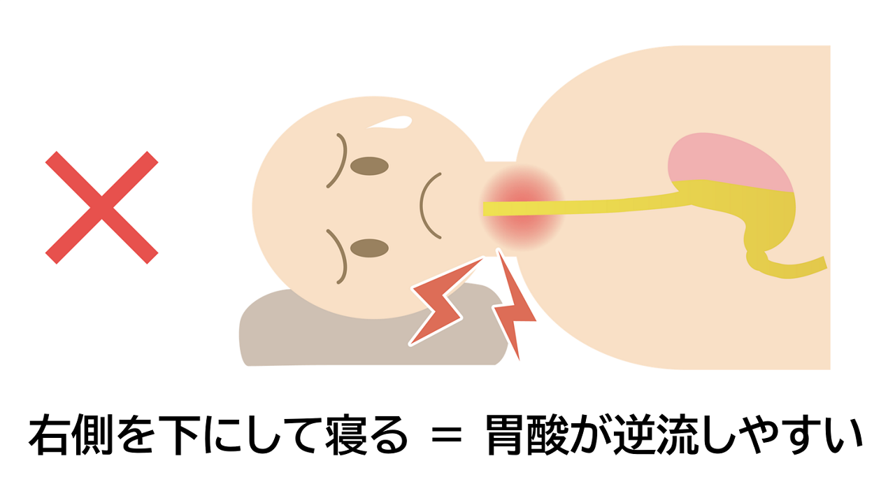 体の右側を下にして寝ると、胃酸が逆流やすいことを示すイメージイラスト