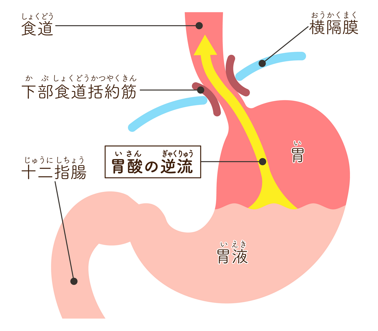 胃酸が逆流するときの胃の様子を示すイメージイラスト