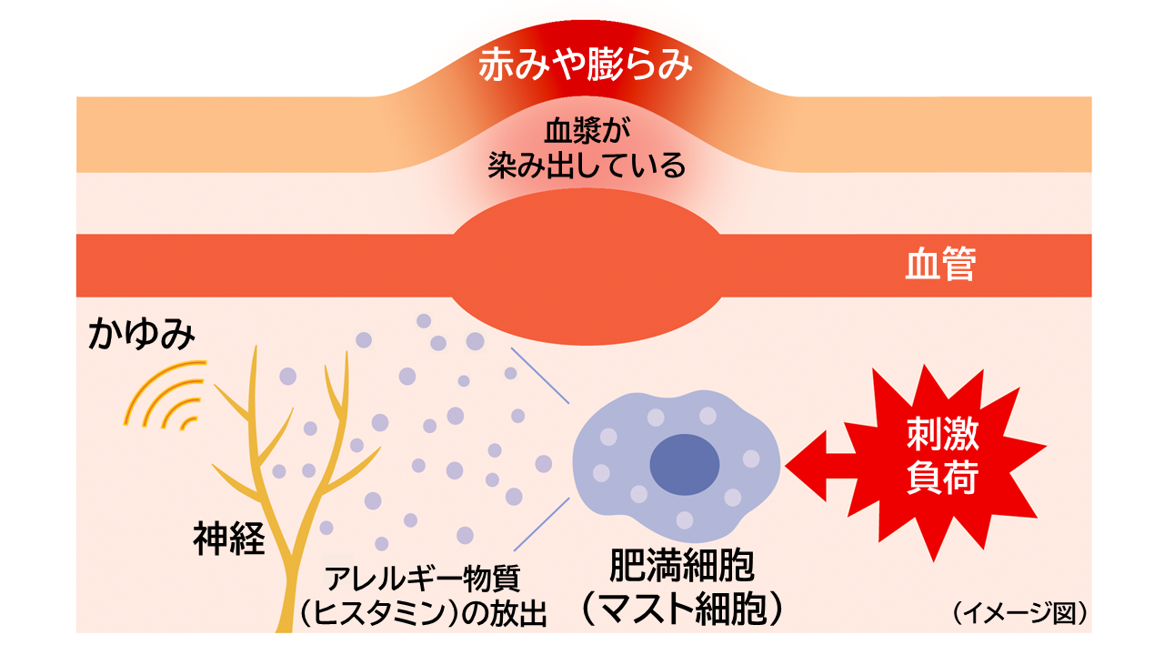 じんましん（蕁麻疹）を引き起こすメカニズムのイメージイラスト