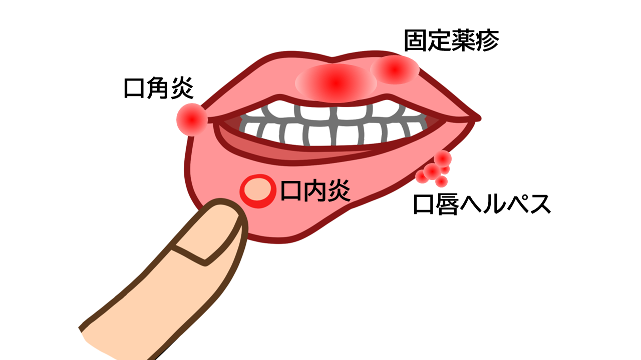口唇炎と似た病気（口角炎、口内炎、口唇ヘルペス、固定薬疹）のイメージイラスト