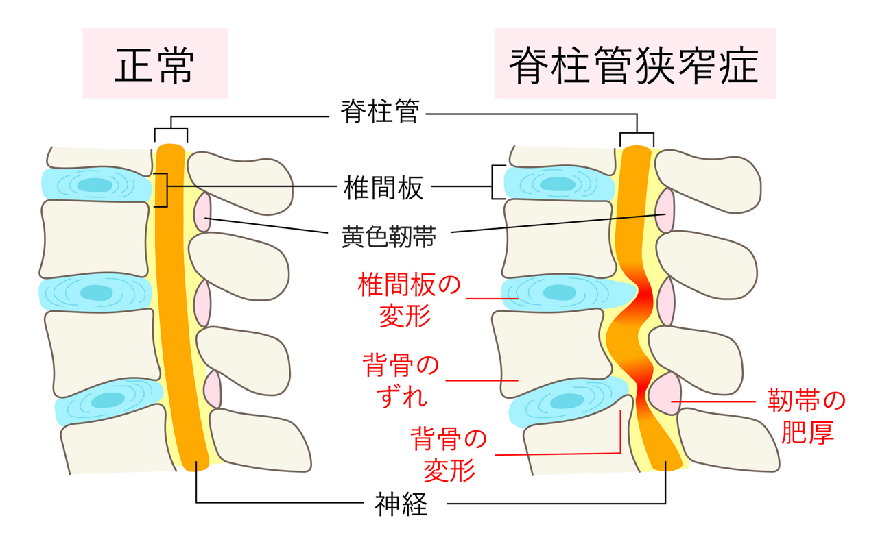 正常な背骨と、脊柱管狭窄症の背骨の状態を比較したイメージ画像。椎間板の変形、背骨のずれ、背骨の変形、靭帯の肥厚などが起こる。