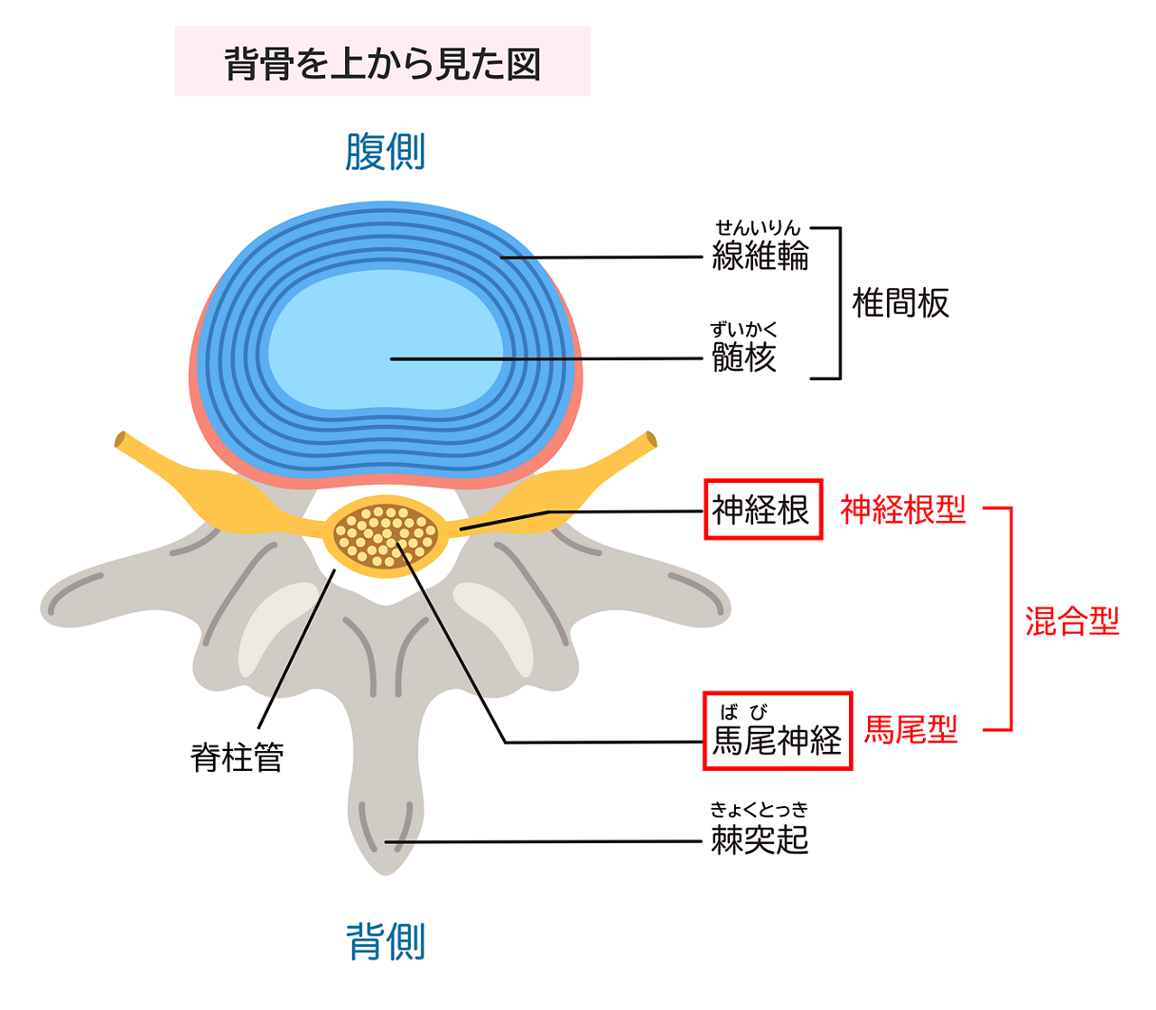 脊柱管狭窄症には主に「神経根型」「馬尾型」「混合型」3タイプあり、脊柱管のどこが圧迫されているかで異なることを示したイメージイラスト