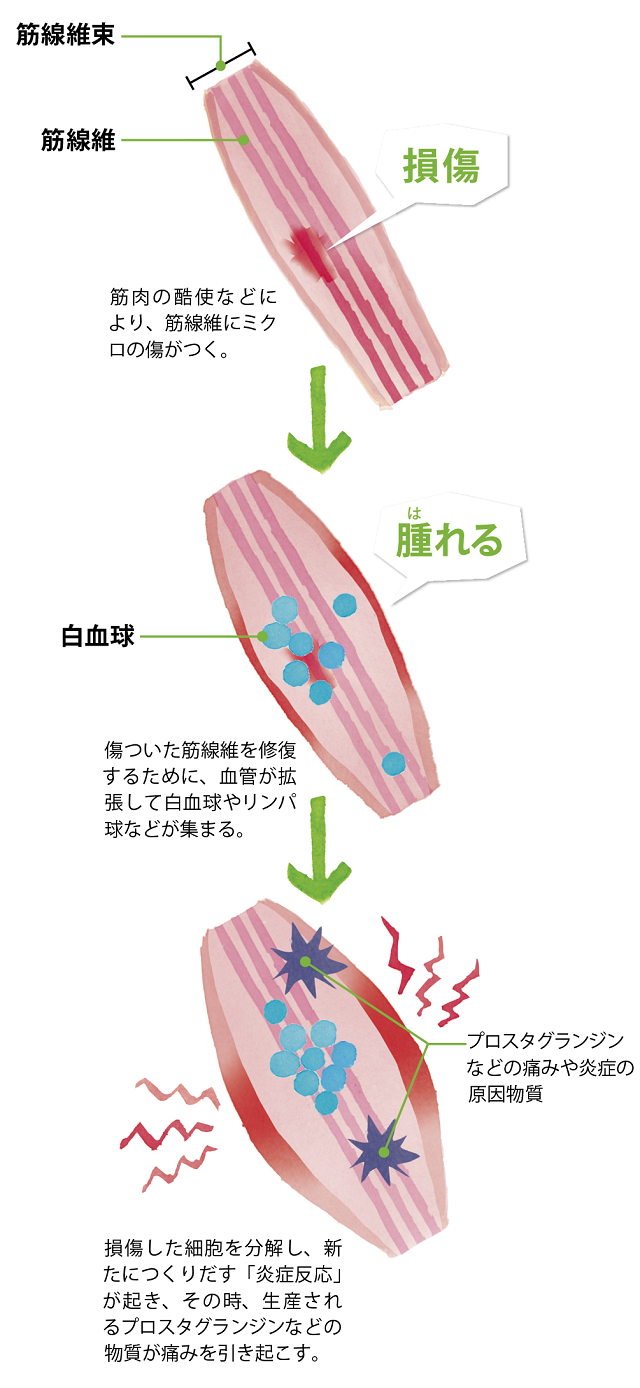 筋肉痛の原因