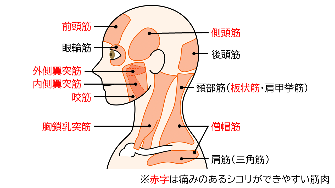 首こりに関与する筋肉のイラスト。特に、前頭筋、側頭筋、外側翼突筋、内側翼突筋、咬筋、板状筋、僧帽筋は、痛みのあるしこりができやすい筋肉。