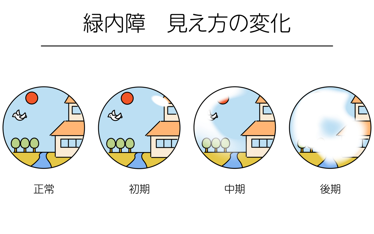 緑内障の初期・中期・後期における視野の変化のイメージイラスト