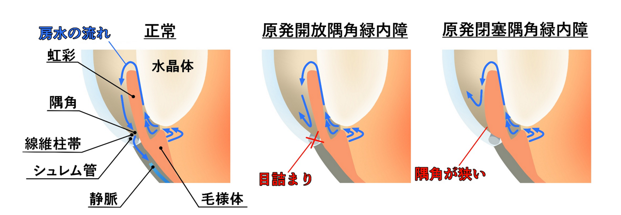 隅角の構造について。原発開放隅角緑内障と原発閉塞隅角緑内障の違いを示すイラスト