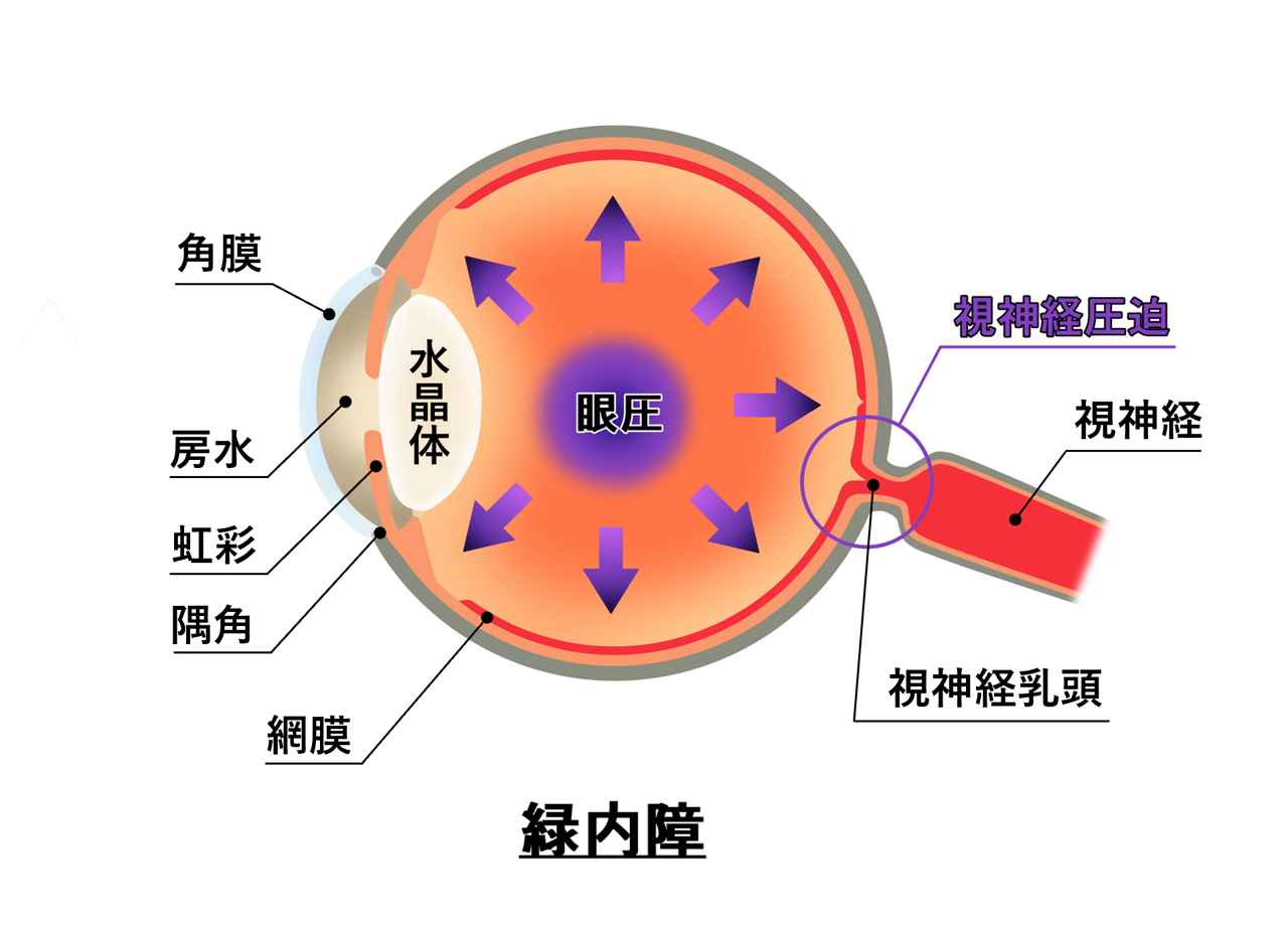緑内障とは。緑内障に関係する眼圧と視神経への圧力を示す目の断面図