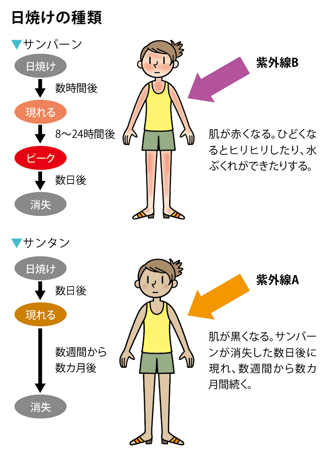 日焼けの種類